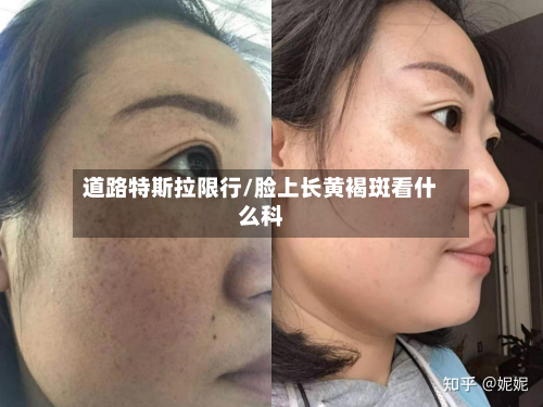 道路特斯拉限行/脸上长黄褐斑看什么科